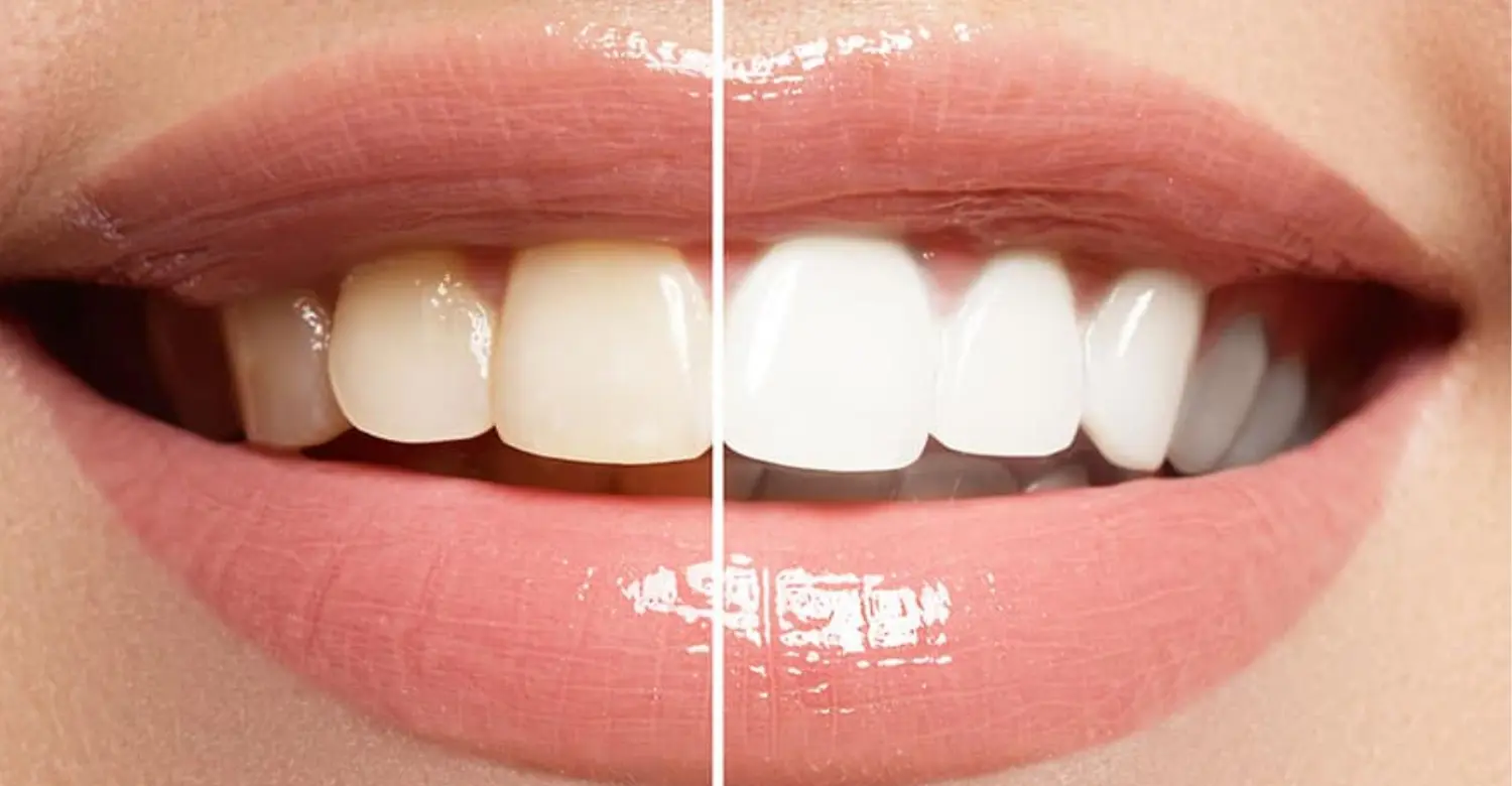 Veneer Maintenance Tips 2